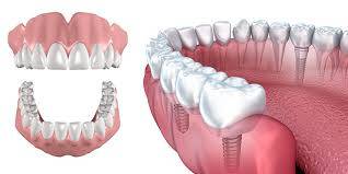Dentures or Implants?