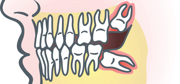 Third molars: to remove or not to remove