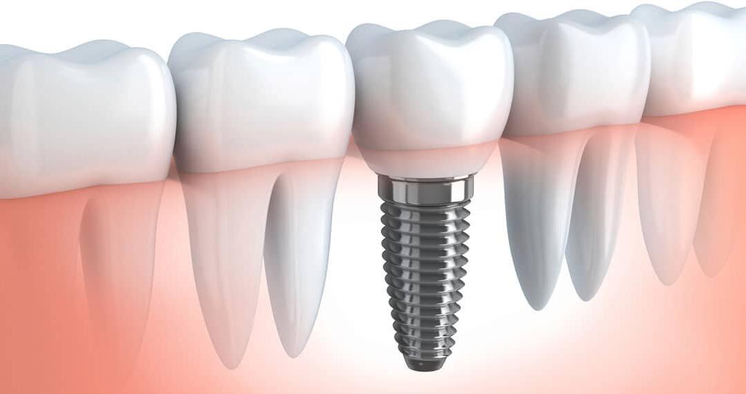 Screw in Teeth!