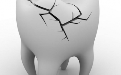 Facial Trauma – What to do in a dental emergency