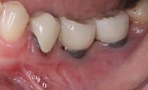 Dental Hygienists Save Implants