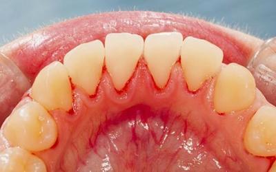 Australian’s dental health is getting worse!