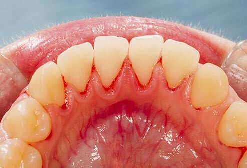 Australian’s dental health is getting worse!