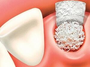 Bone grafting for implant therapy – PH-54