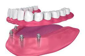 Dental clearance and tooth replacement options – PH-55