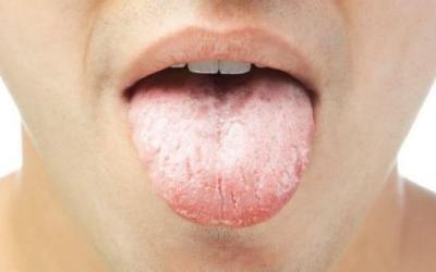 Dry mouth (also known as Xerostomia) – PH-51